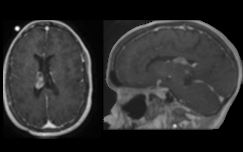 BrainPath Approach for Brain Biopsy