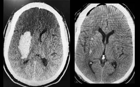 BrainPath Approach for Intracerebral Hemorrhage