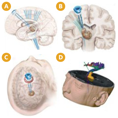 Nico BrainPath can result in less trauma to the patient and shorter recovery times. Nico BrainPath can result in less trauma to the patient and shorter recovery times.
