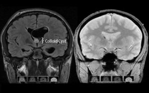 NICO Myriad with Ventriculoscope