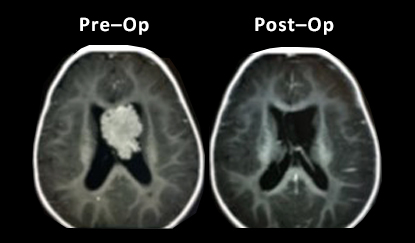 Clinical Outcomes Tumor