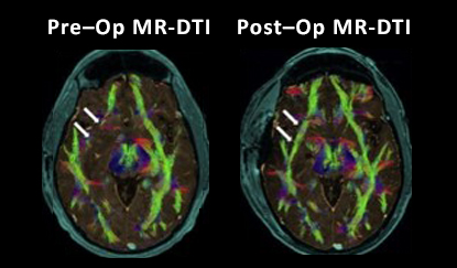 economic outcomes of tumor and brain biopsy NICO