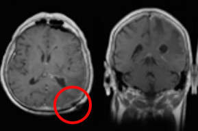 Parafascicular Surgery using Brainpath parafascicular-approach-brainpath