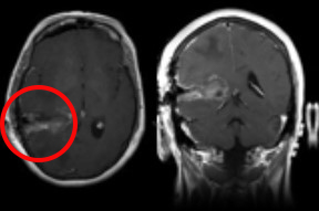 Conventional Brain Surgery Parafascicular parafascicular-approach-conventional