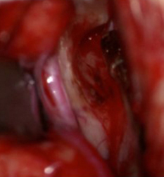 Surgery with NOVUS WITHOUT using Xenon Light