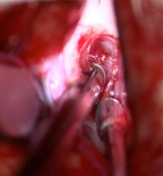 Surgery with NOVUS using Xenon light