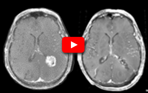 NICO Brain Metastases