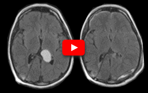 BrainPath Approach for Subcortical Primary Tumors